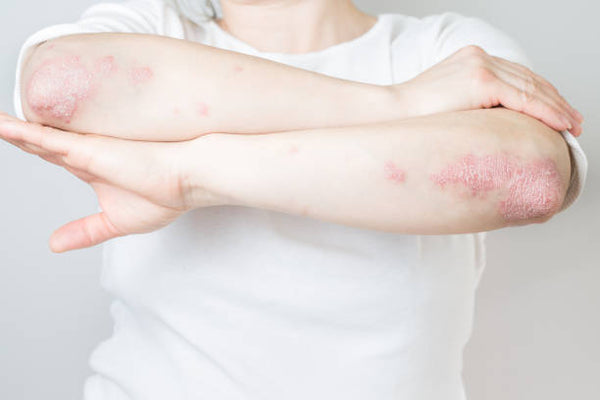What Causes Psoriasis?